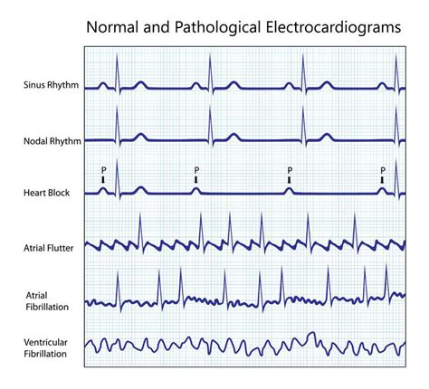 Atrial Fibrillation - Cardiology - Highland Hospital - University of ...