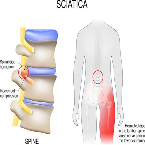 Symptoms Of Sciatica Buttock