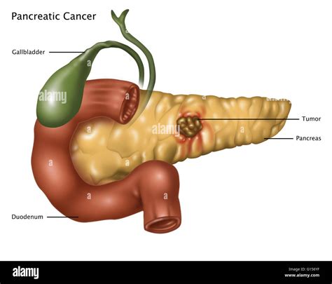 Illustration of pancreatic cancer. At center of the pancreas is a tumor ...