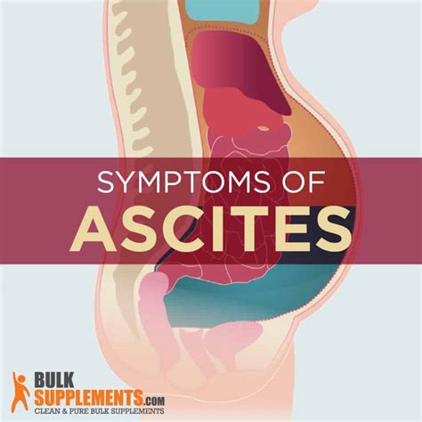 Ascites: Symptoms, Causes & Treatment