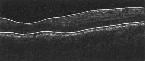 Sample OCT scan showing measurement points and marked boundaries ...