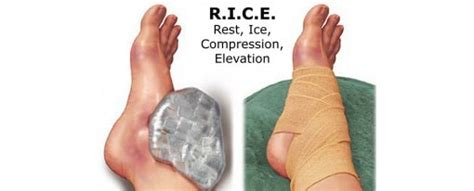 How Long should you Rest and Ice a Sprained Ankle?