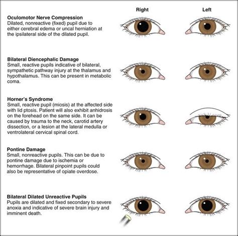 Pupil Eye Chart Size