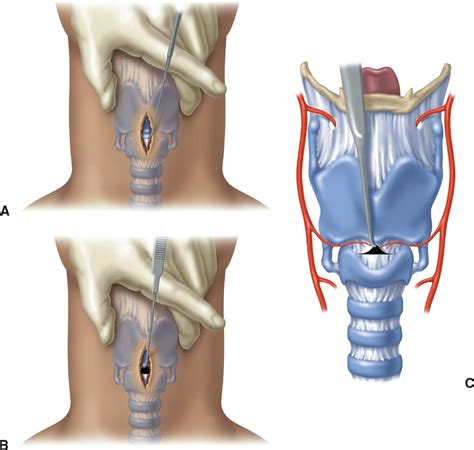 Cricothyroidotomy Anatomy