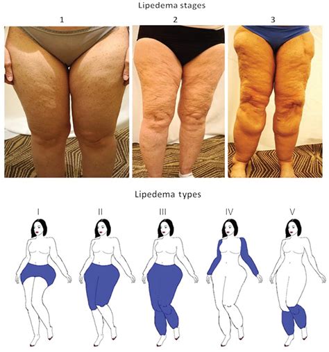 Lipedema: friend and foe