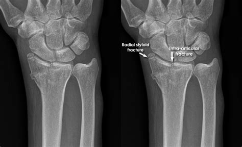 Trauma X-ray - Upper limb gallery 2 - Distal radius fracture