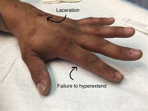 Extensor Tendon Injuries, Part II – Closing the Gap