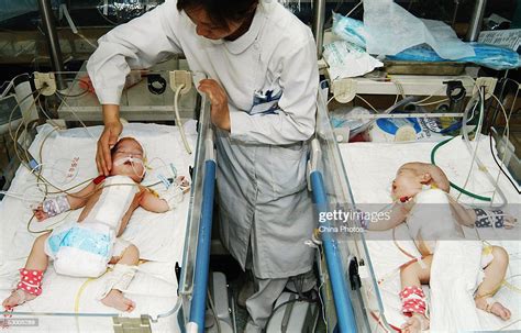 A nurse checks a pair of Siamese twins from Shanxi Province after ...