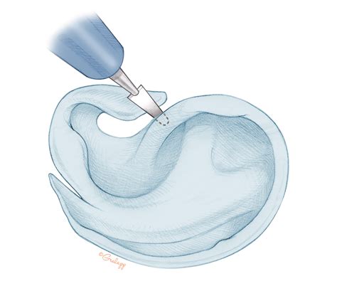 Postauricular Meatoplasty – Oto Surgery Atlas