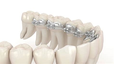 Lingual Braces: Pros, Cons, Cost, And Comfort