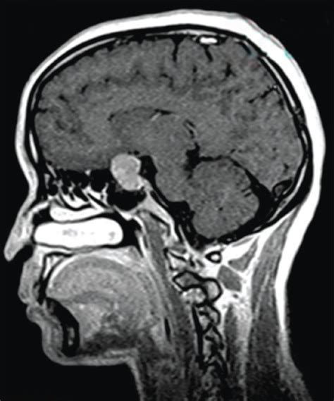 MRI finding of pituitary tumors. | Download Scientific Diagram