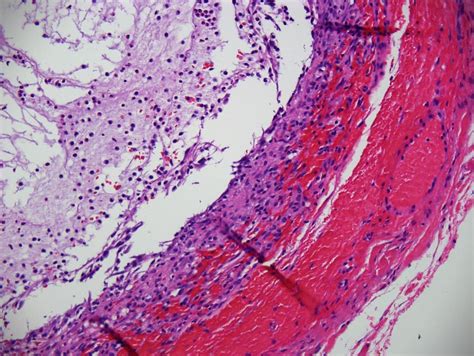 Mucocele Histology