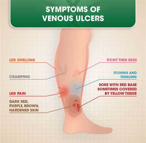 Venous Ulcers | DOC Vein Management