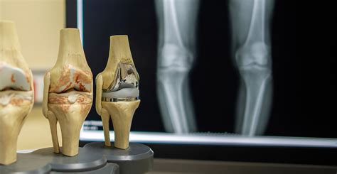 Advanced Total Knee Replacement Surgery in India at Affordable Rates ...