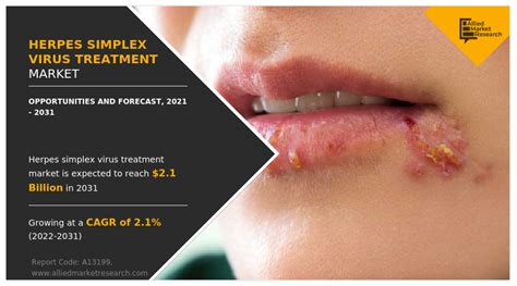 Herpes Simplex Virus Treatment Market Statistics and Forecast - 2031