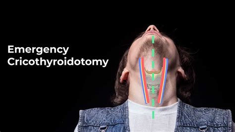 Performing an Emergent Cricothyroidotomy - MEDZCOOL - YouTube