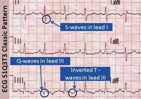 S1Q3T3 pattern on ECG in a patient with acute massive - MEDizzy