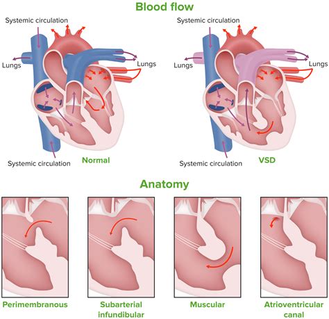 Ventricular Septal Defect (VSD) | Concise Medical Knowledge