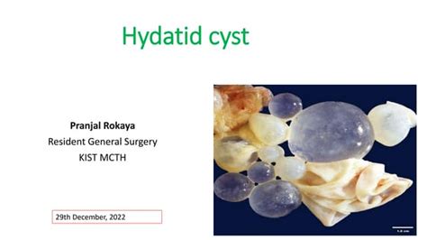 Hydatid Cyst | PPT