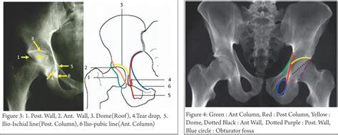 Understanding Clinical Radiology of Fracture Acetabulum – Trauma ...