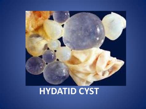 Hydatid Cyst Stages