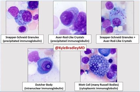 IgA Myeloma_ Dutcher bodies in 2022 | Floral rings, Floral, Body