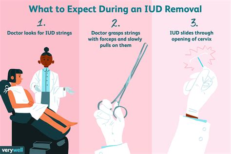 What to Expect During Your IUD Removal