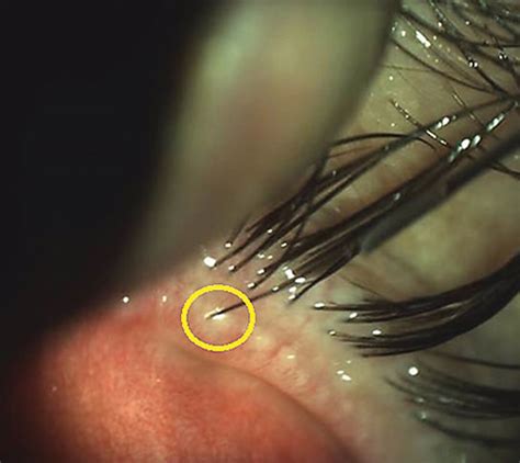 Dry Eye and Systemic Disease: What’s the Association?