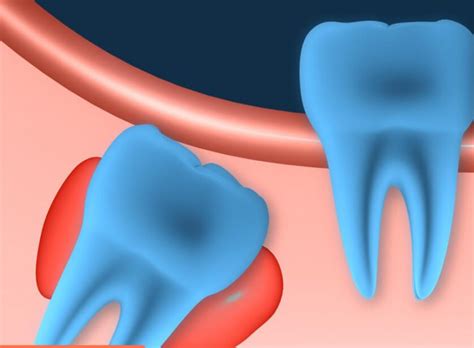 Full list of 6 dental cyst types. What is a cyst on a tooth? How ...