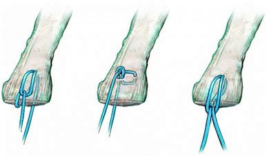 The different stitch configurations. From left to right: lasso-loop ...