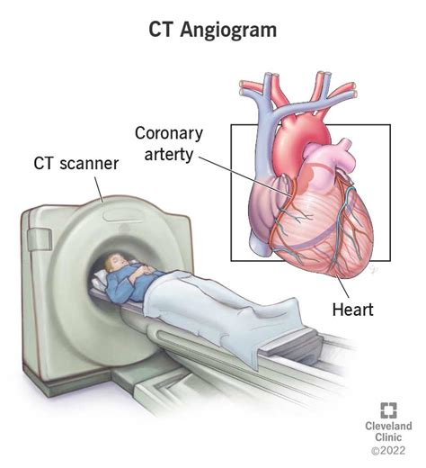 CT Coronary Angiogram