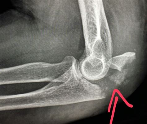 #Elbow #xray shows a #fracture of the #ulna (#olecranon) in a #patient ...