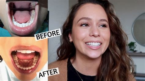 Invisalign Before-and-After - what you can achieve | Simply Teeth Essex