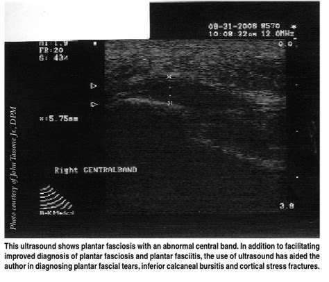 Diagnostic Ultrasound: Can It Have An Impact For Plantar Fasciitis?