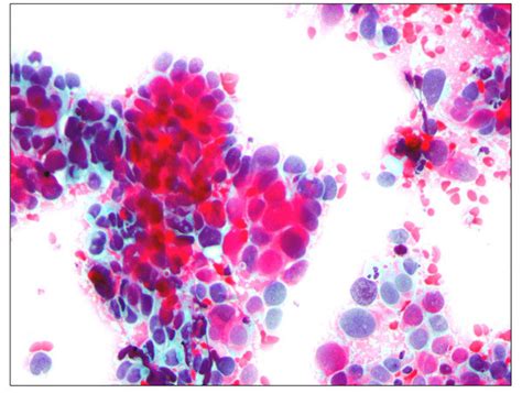 Pap smear showing cervical cancer. Pap staining in a patient with ...