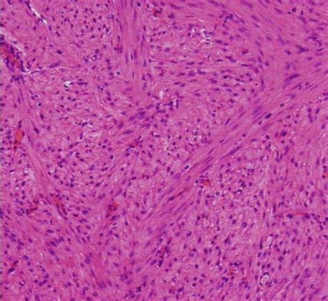 Uterine Leiomyoma and Leiomyosarcoma | Concise Medical Knowledge