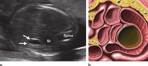 Enteric duplication cyst. (a) Axial fetal US image shows an enteric ...