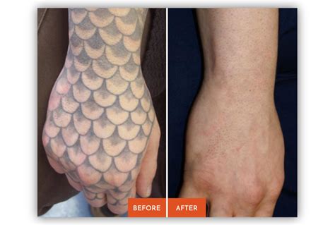 Laser Tattoo Removal in Kingston, NY - Ink Inc Tattooing