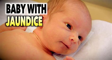 Jaundice In Newborns - Causes, Signs, Symptoms, Diagnosis & Treatment