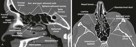 Nasal Bone Anatomy Radiology - Radiographic Anatomy - Sinuses - Lateral ...