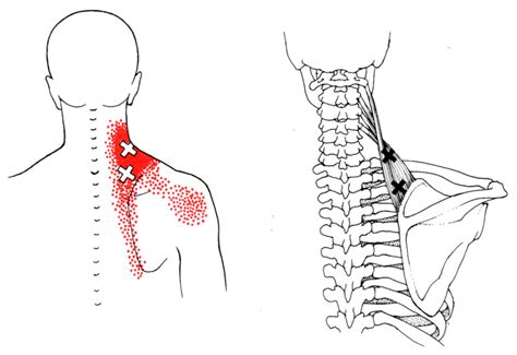 Levator Scapulae | The Trigger Point & Referred Pain Guide