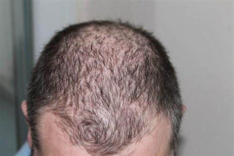 Men Hair Loss Causes And Therapies - Understanding Male Style Baldness ...