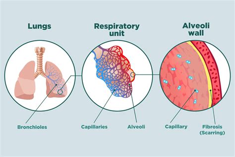 Facts About Pulmonary Fibrosis