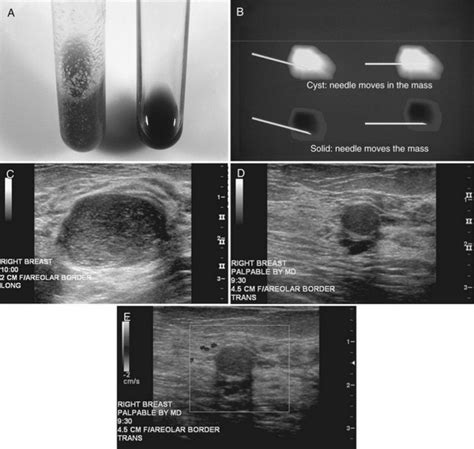 Breast Ultrasound Radiology Key