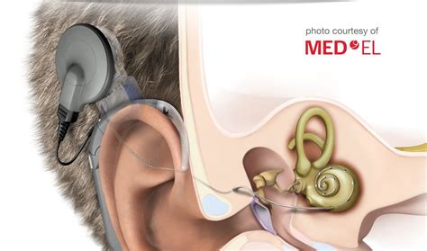 cochlear implant by Med-el is discuss at the meetingd | Trợ thính, Phẫu ...