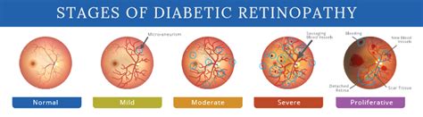 GitHub - BalajiAI/Diabetic-Retinopathy-Detection-using-Deep-learning: A ...