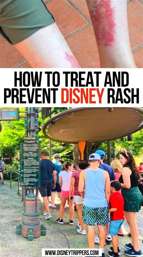 How To Treat And Prevent Disney Rash | Disney rash, Disney world tips ...