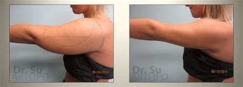 Arm Liposuction Before and After Results Large