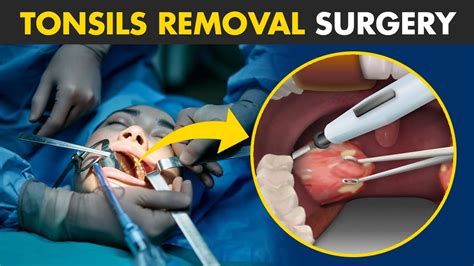 How Tonsillectomy Procedure Is Performed? | Tonsils Removal Surgery ...