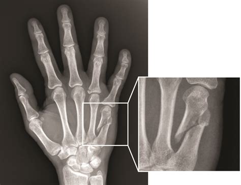 Hand Fracture - Raleigh Hand Surgery — Joseph J. Schreiber, MD